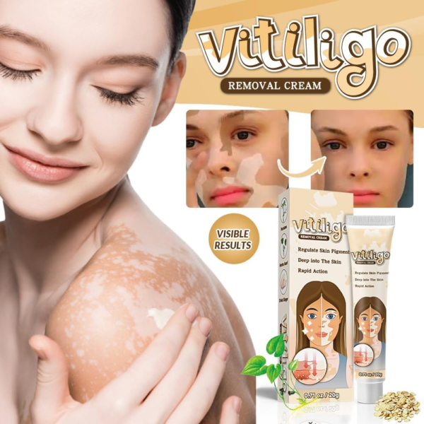 Natural_Vitiligo_Cream_2 Natural Vitiligo Cream