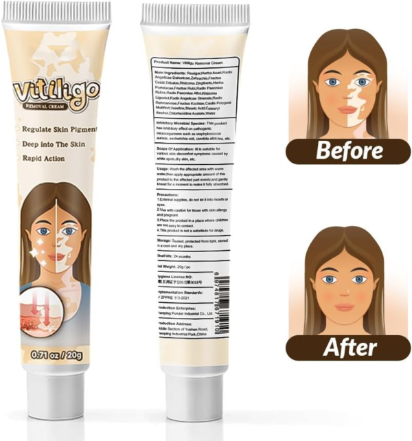 Natural_Vitiligo_Cream_3 Natural Vitiligo Cream