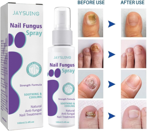 image1_ec665489-1372-4ec3-9a78-b3f97be7a512 Extra Strong Nail Fungus Treatment Spray - 100ml