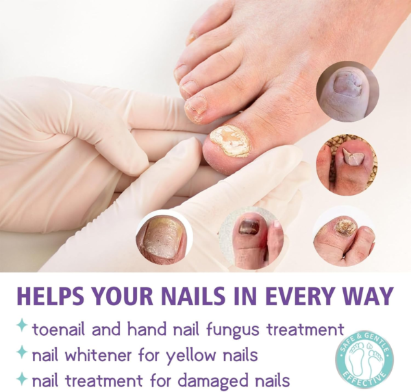 image2_63809fc2-fc3e-42c5-82a1-a64e4bab265a Extra Strong Nail Fungus Treatment Spray - 100ml